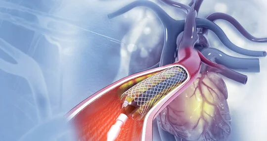 Angioplasty treatment