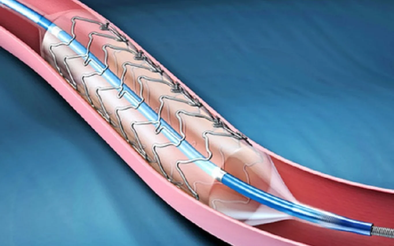 Balloon Valvotomy (1)