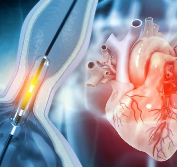 Cardiac Catheterisation