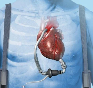 LVAD Implantation